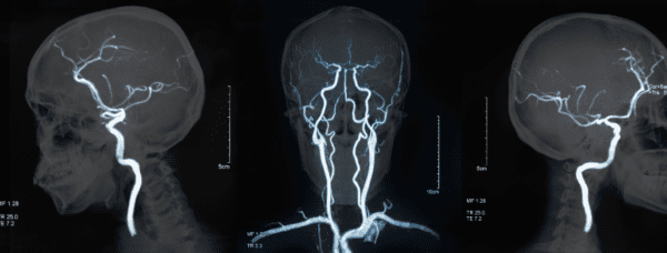 Brain Injury Lawyer in Philadelphia Jared S. Zafran, LLC